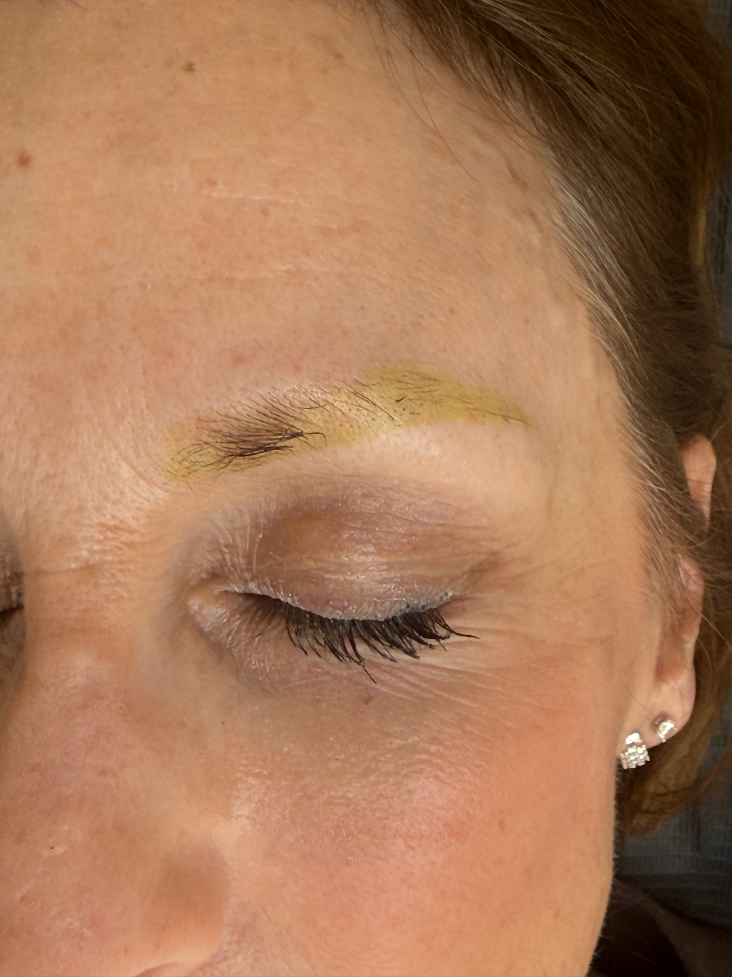 Yellow residual pigment on a mature eyebrow after multiple laser removal sessions — Browboutique Cascais
